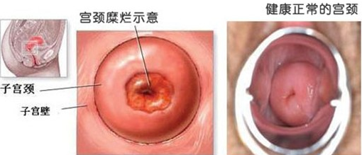 运城引起宫颈糜烂的原因都有哪些